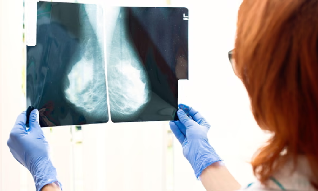 Simple blood test can predict which breast cancer treatment will work best, study finds